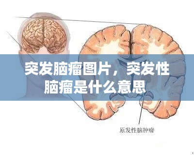 突发脑瘤图片,突发性脑瘤是什么意思